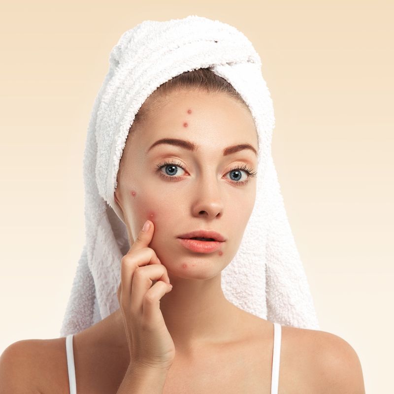 ঘরোয়া উপায়ে ব্রণ কমানো