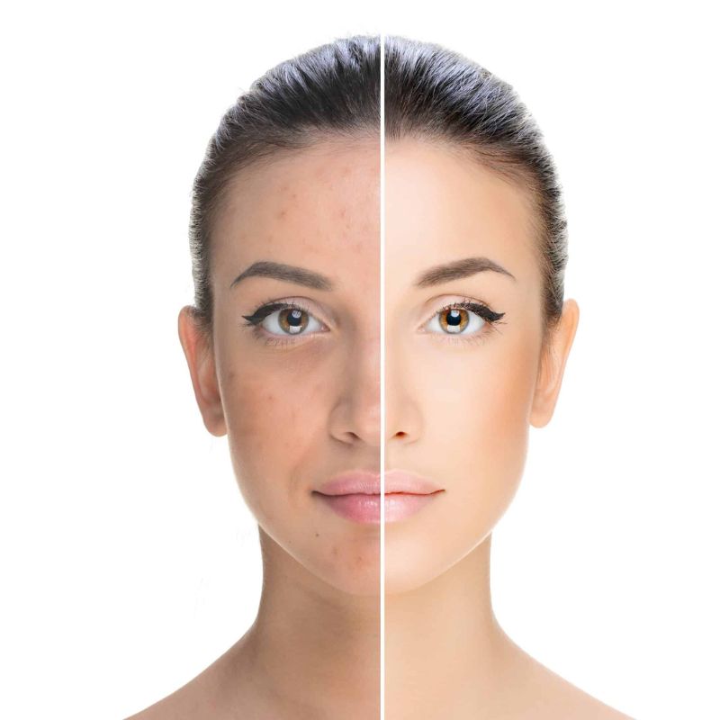 স্কিন ট্যান দূর করা