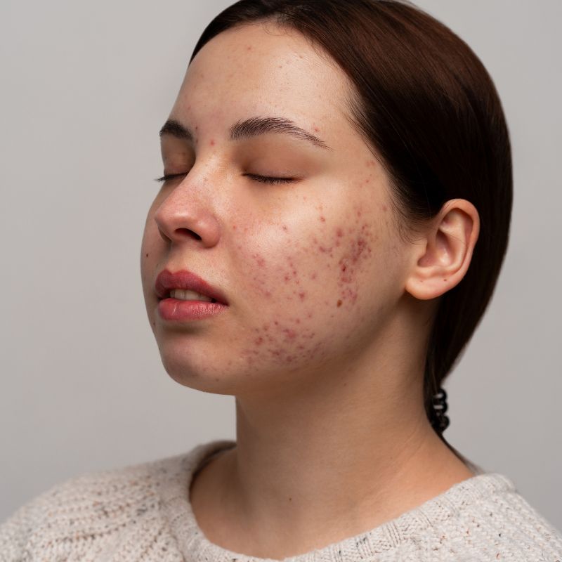 ব্রণপ্রবণ ত্বকের জন্য বিউটি টিপস